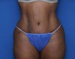 Liposuction - Case 7232 - After