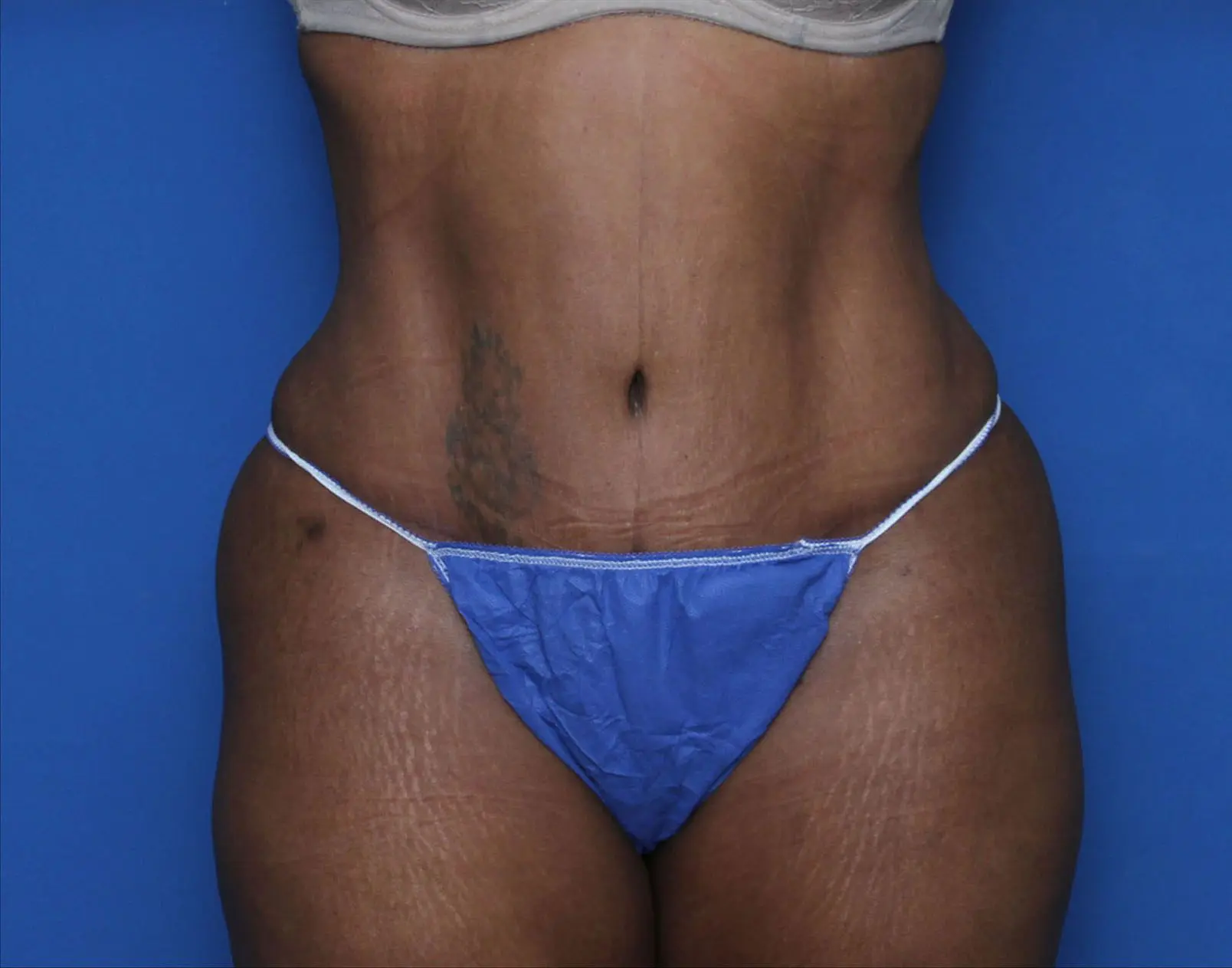 Liposuction Patient Photo - Case 7232 - after view