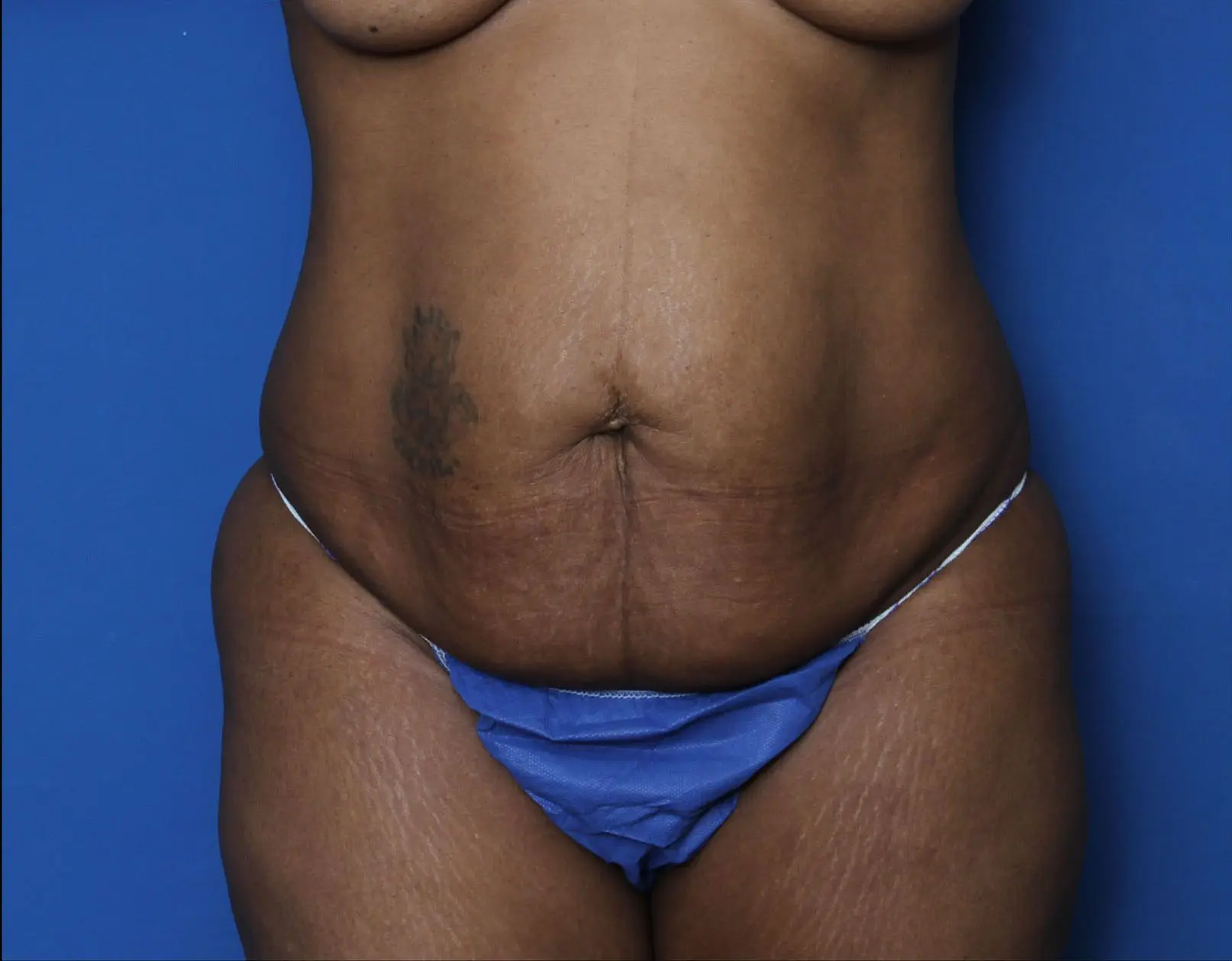 Liposuction Patient Photo - Case 7232 - before view-