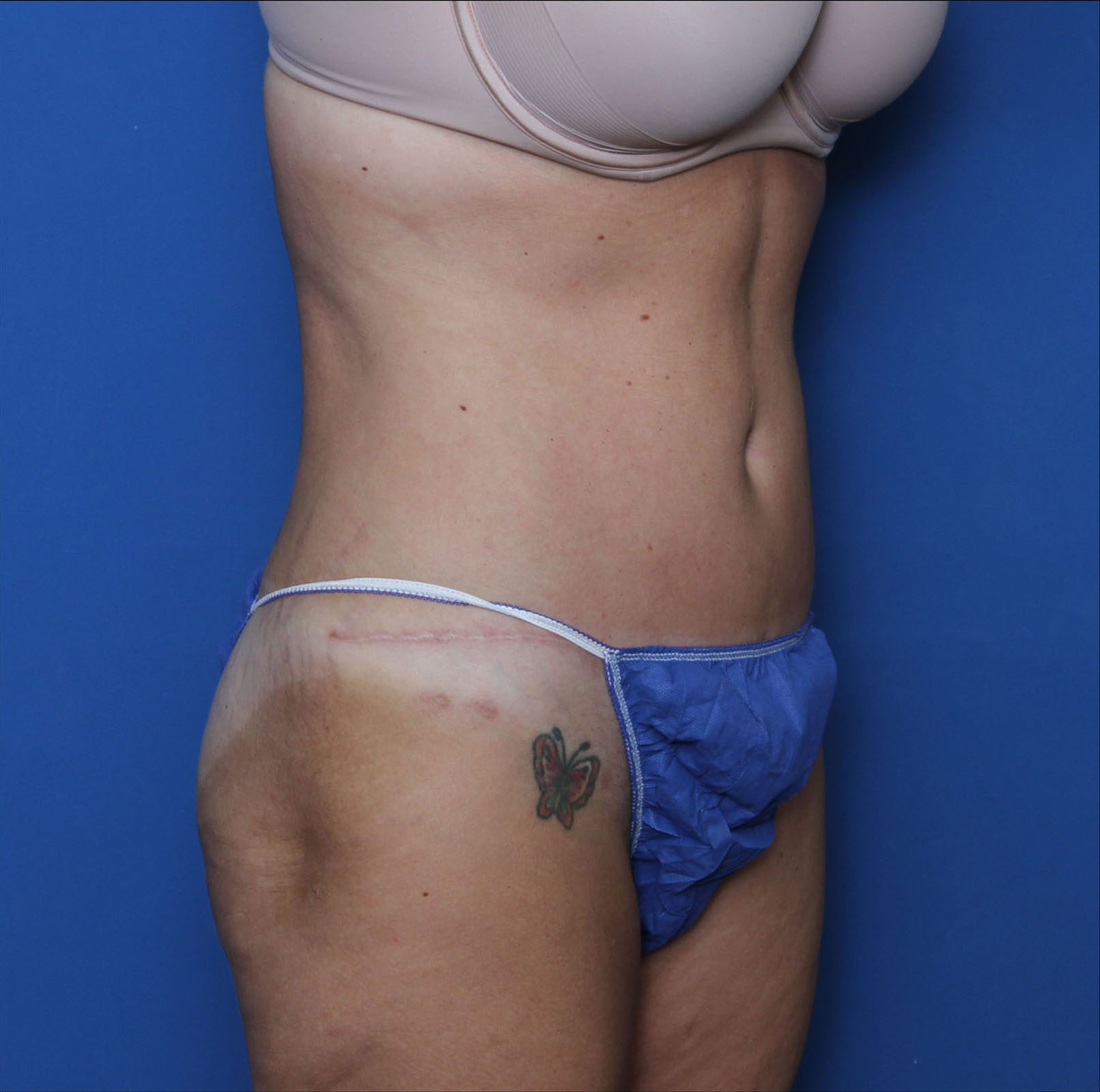 Liposuction Patient Photo - Case 7234 - after view-1