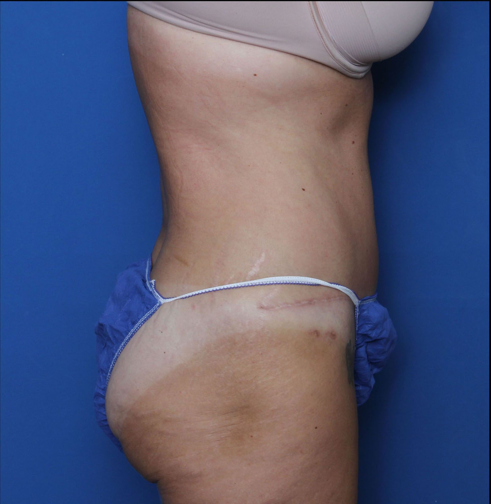 Liposuction Patient Photo - Case 7234 - after view-2