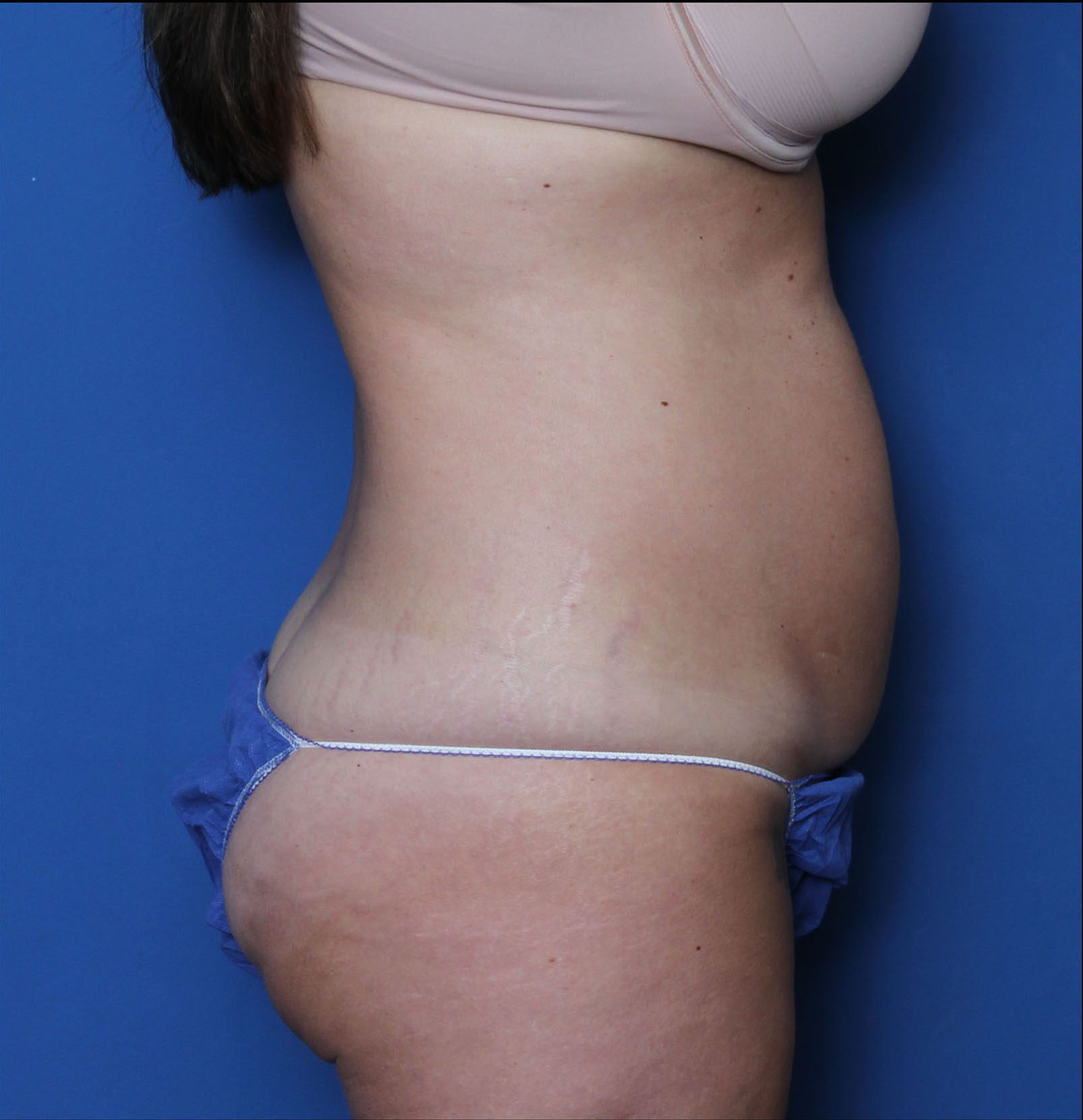 Liposuction Patient Photo - Case 7234 - before view-2