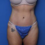 Liposuction - Case 7234 - After