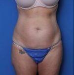 Liposuction - Case 7234 - Before