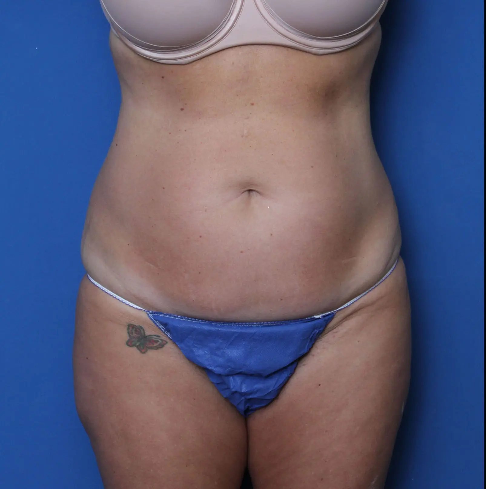 Liposuction Patient Photo - Case 7234 - before view-
