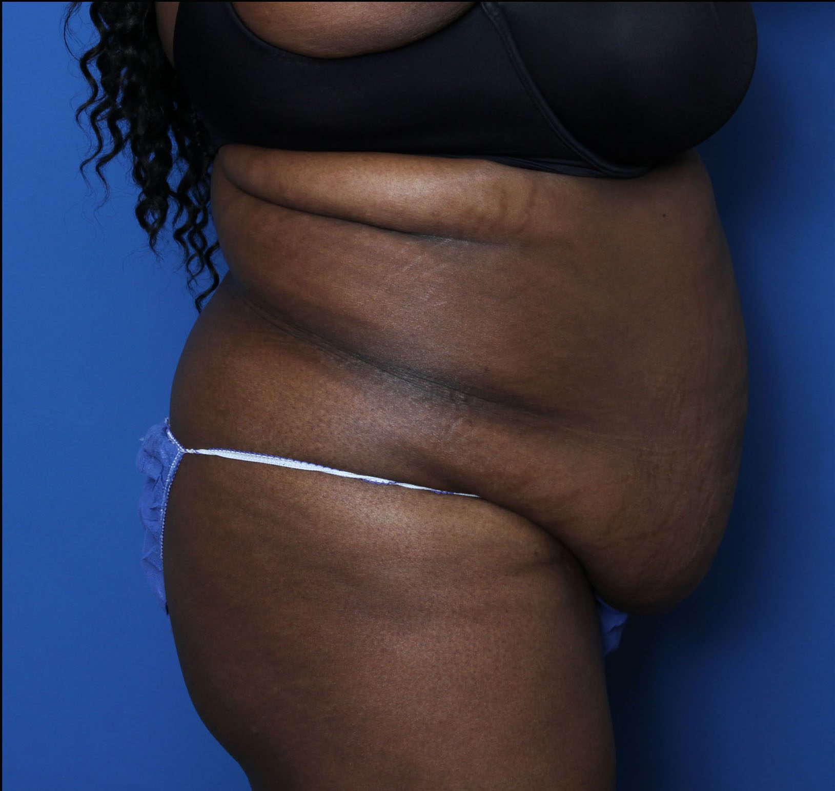 Tummy Tuck Patient Photo - Case 6962 - before view-2
