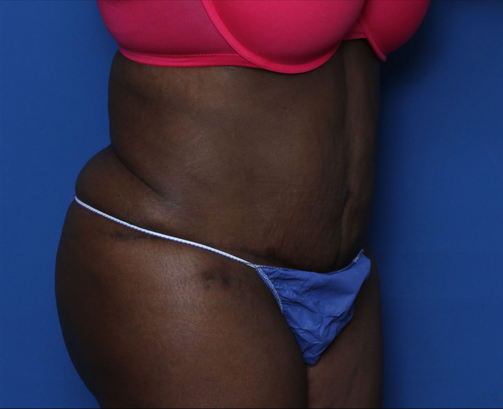 Tummy Tuck Patient Photo - Case 6962 - after view-1