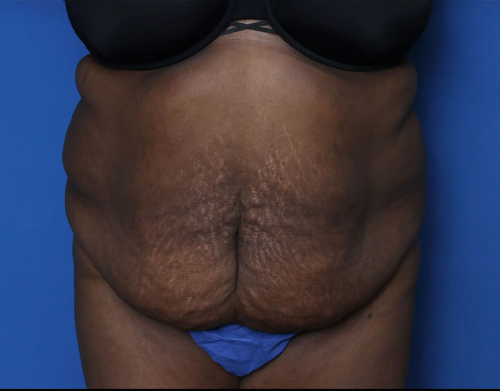 Tummy Tuck Patient Photo - Case 6962 - before view-