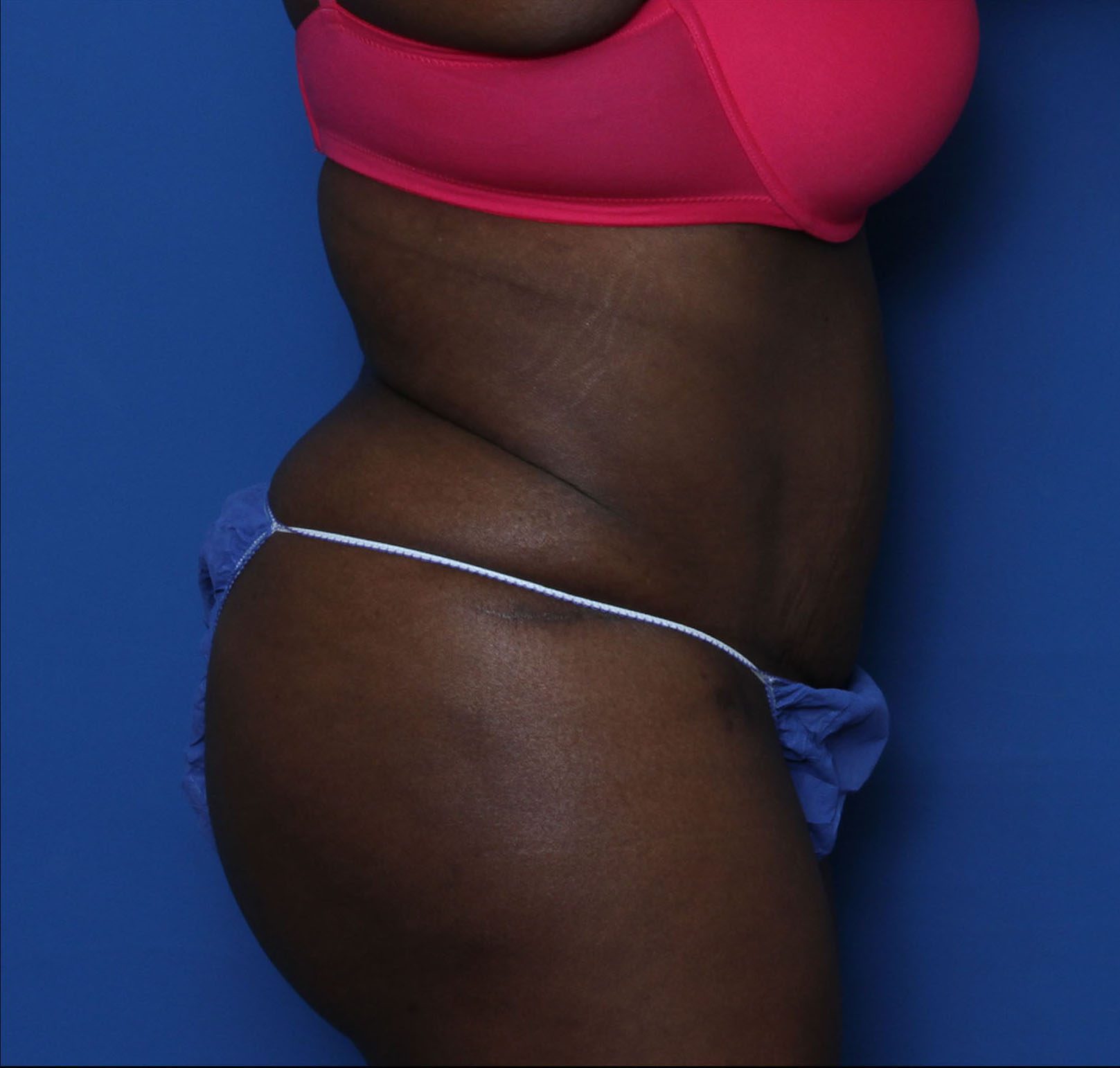 Tummy Tuck Patient Photo - Case 6962 - after view-2