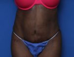 Tummy Tuck - Case 6962 - After