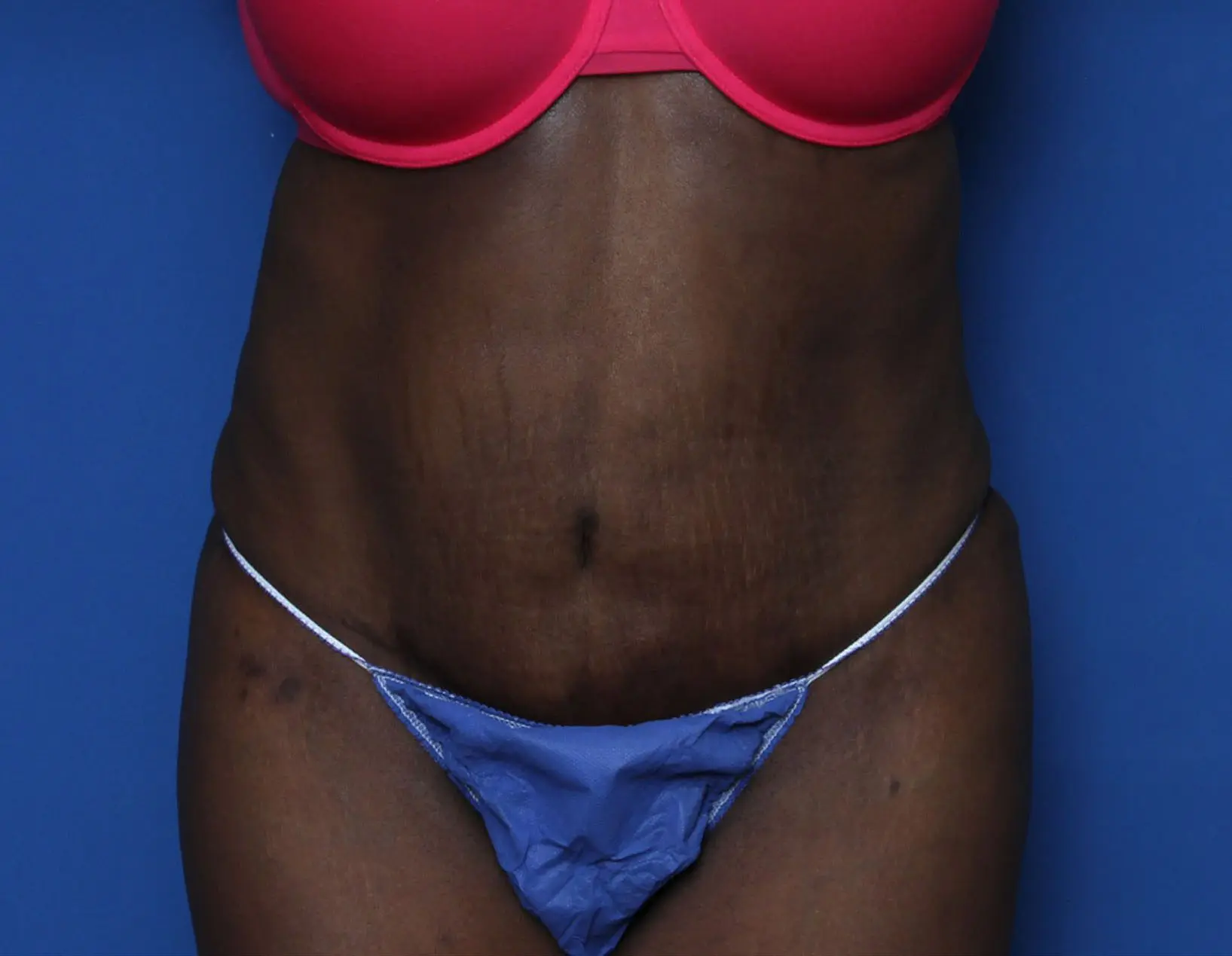 Tummy Tuck Patient Photo - Case 6962 - after view