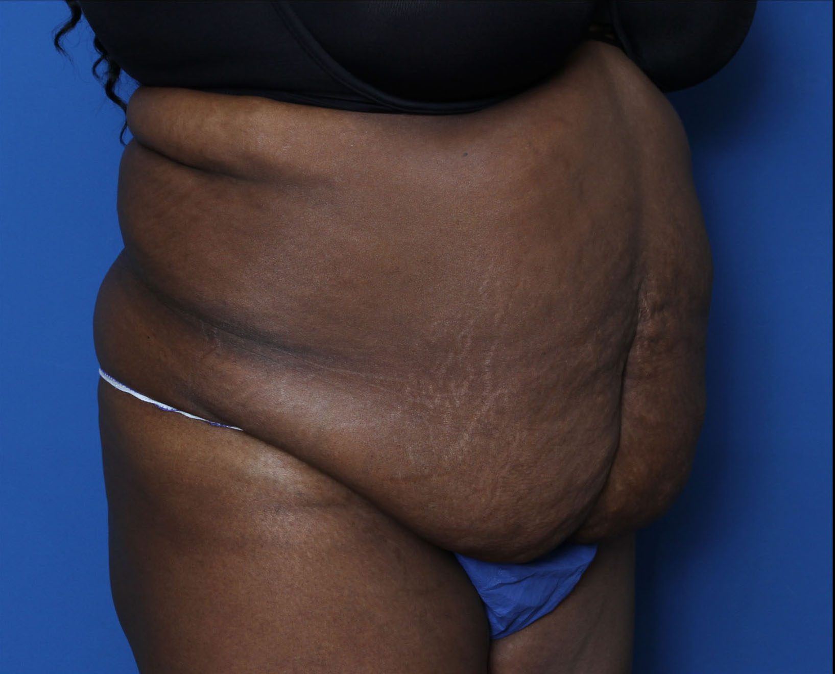 Tummy Tuck Patient Photo - Case 6962 - before view-1