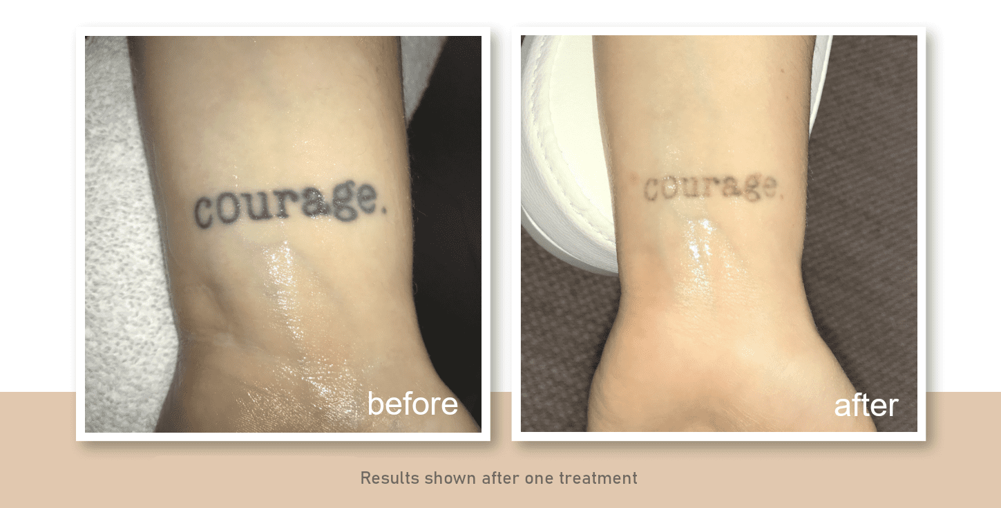tattoo removal before and after patient