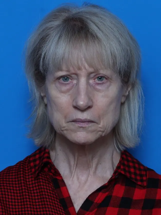 Brow Lift - Case 8567 - Before