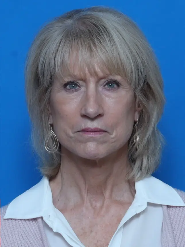 Brow Lift - Case 8567 - After