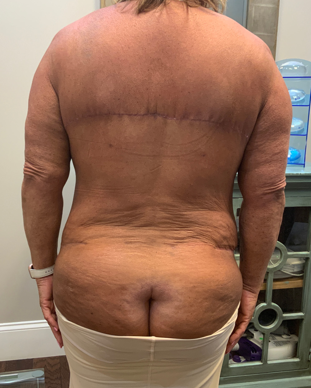 After Weight Loss - Case 13746 - After