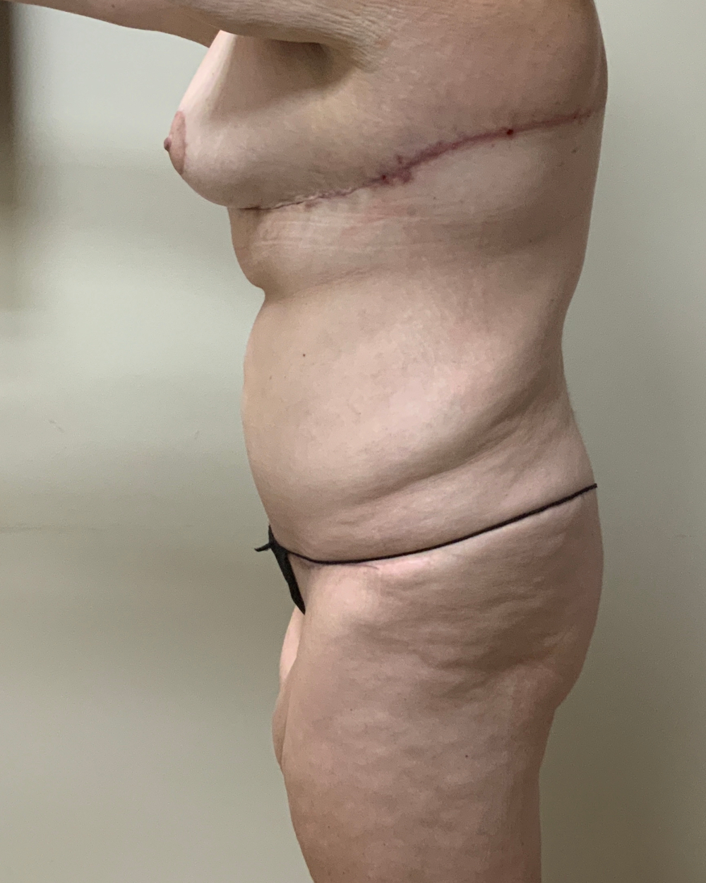 After Weight Loss Patient Photo - Case 13757 - after view-1