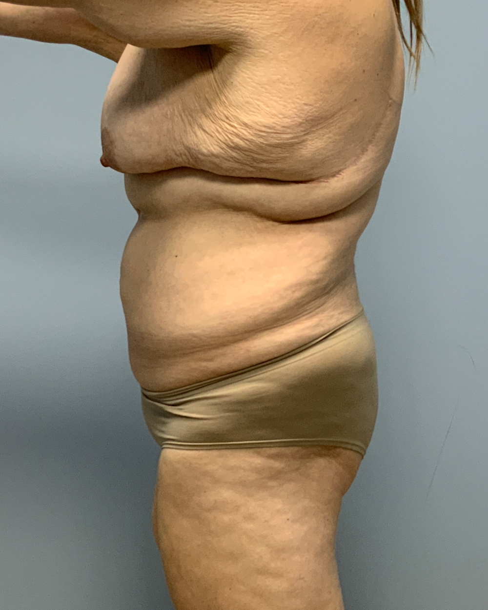 After Weight Loss Patient Photo - Case 13757 - before view-1