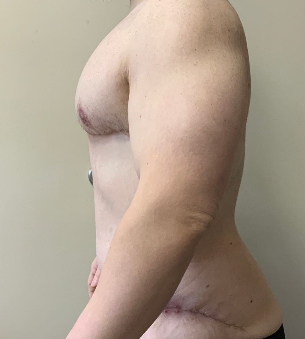 Gynecomastia/Male Chest Lift Patient Photo - Case 13837 - after view-2