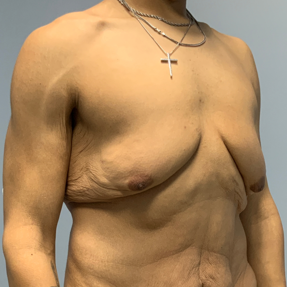 Gynecomastia/Male Chest Lift Patient Photo - Case 13847 - before view-3