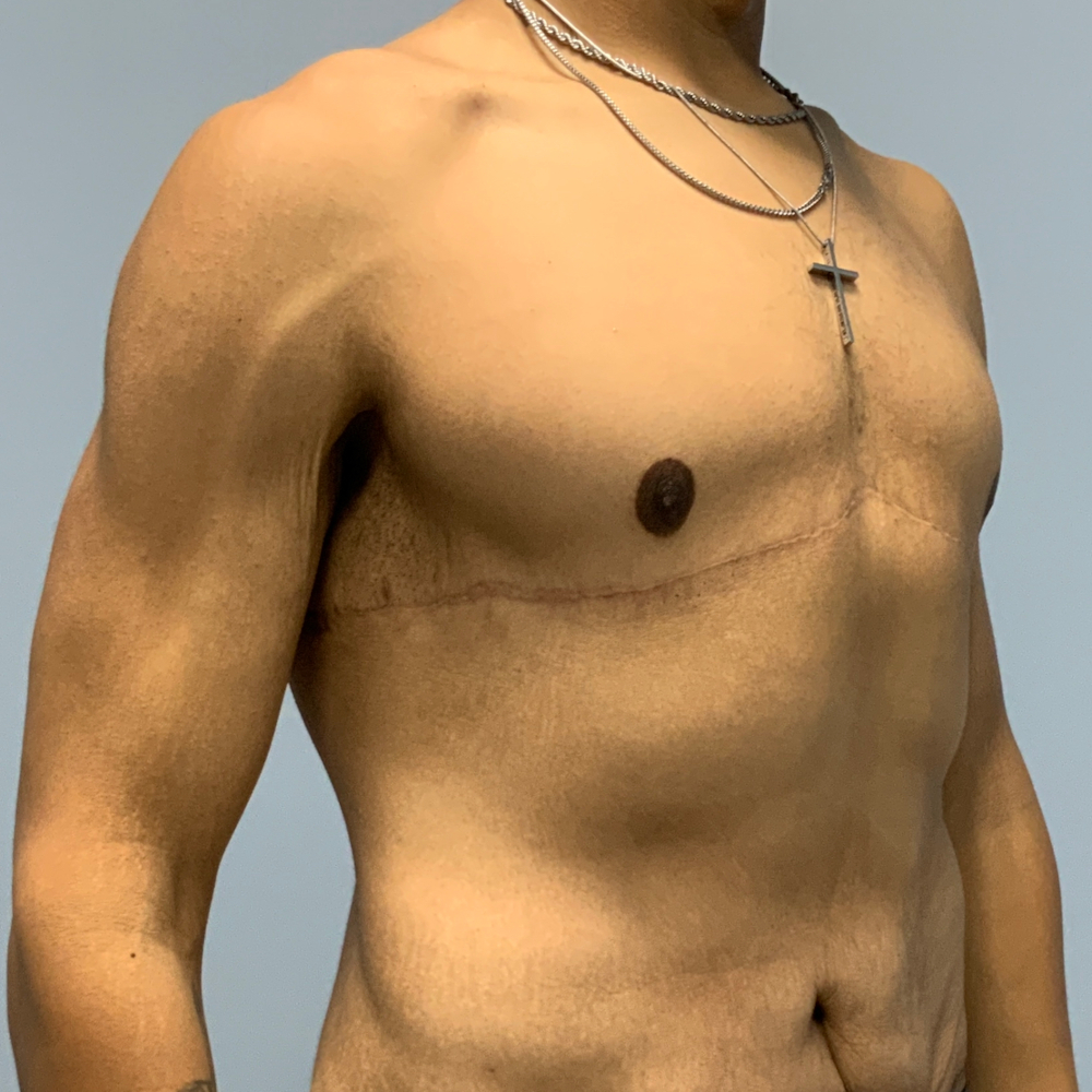 Gynecomastia/Male Chest Lift Patient Photo - Case 13847 - after view-3