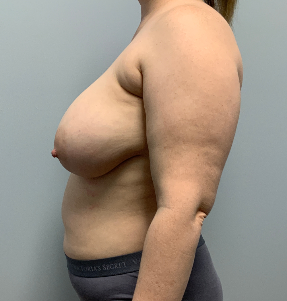 Breast Lift Patient Photo - Case 13859 - before view-2